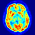 PET-image of brain